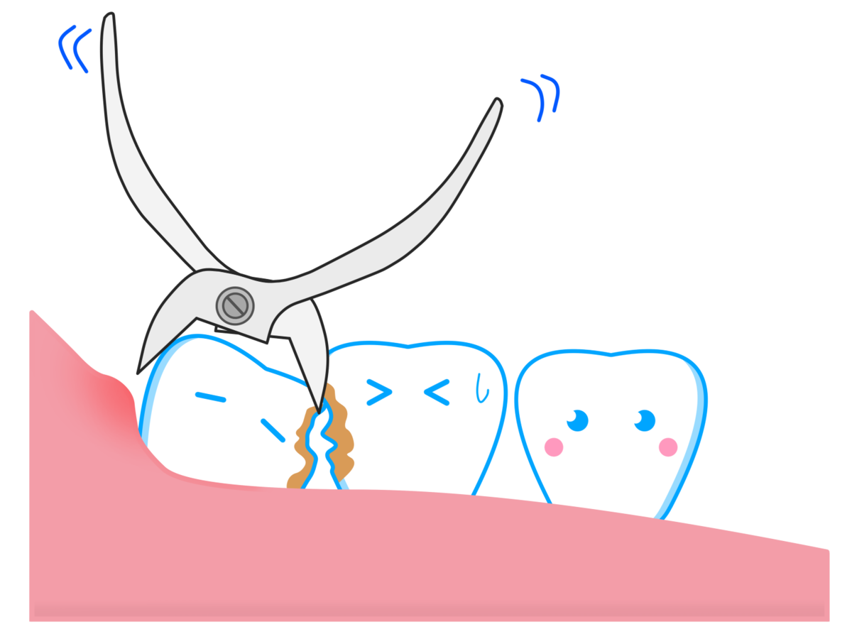 親知らず抜歯